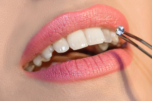 Professional Tooth Gem implants on Scottsdale, Gilbert and Mesa, Arizona